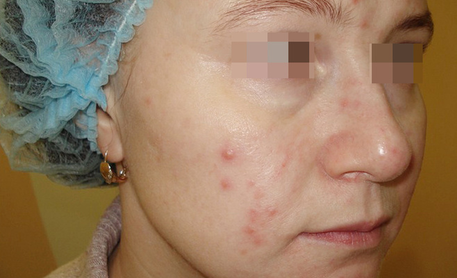 Лазерное лечение угревой болезни до процедуры